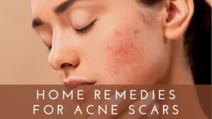 Home Remedies for Acne Scars Overnight